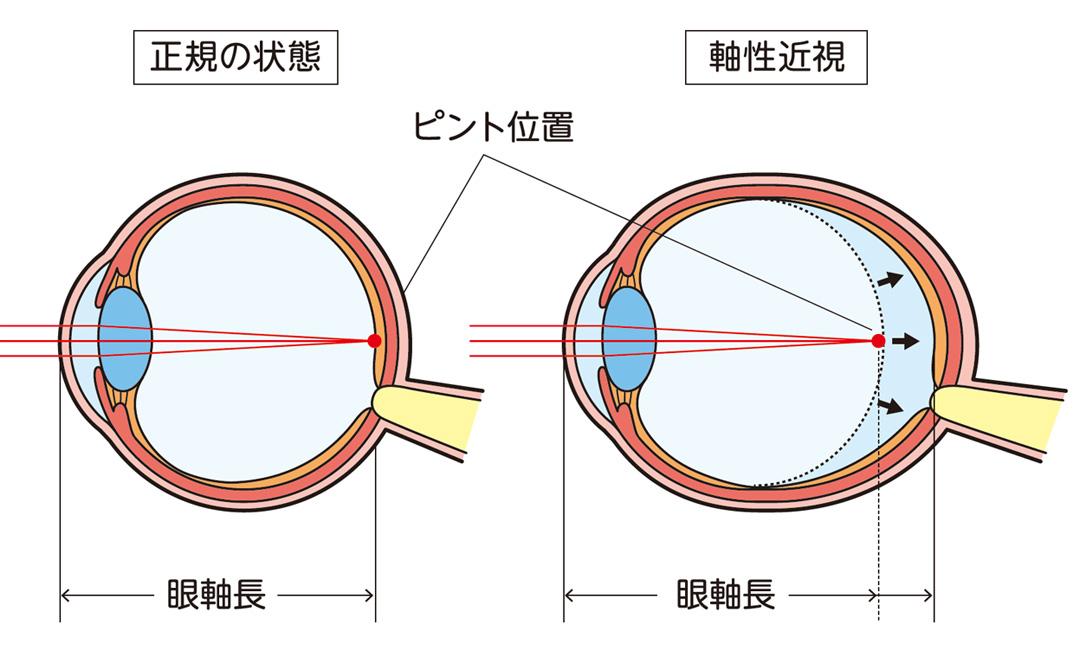 低濃度アトロピン0.01%点眼は眼軸長が伸びるのを抑制する効果